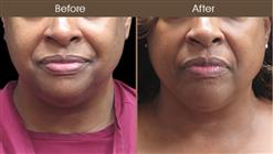 Laser Necklift Before And After
